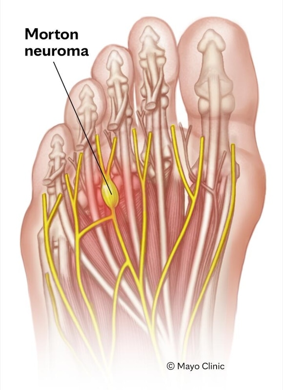 Morton neuroma