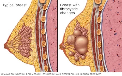 Tejido mamario típico y una mama con cambios fibroquísticos.