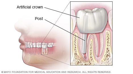 Final results of root canal and crown