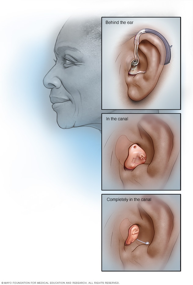 Hearing aid styles