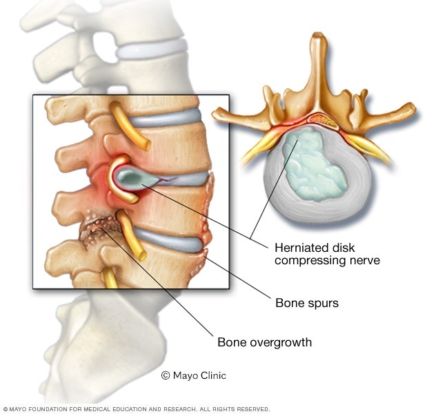 Herniated disk and bone spurs on spine