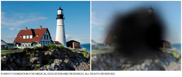 Representación de la visión normal y de la visión con degeneración macular