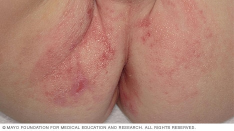 Fotografía de dermatitis del pañal