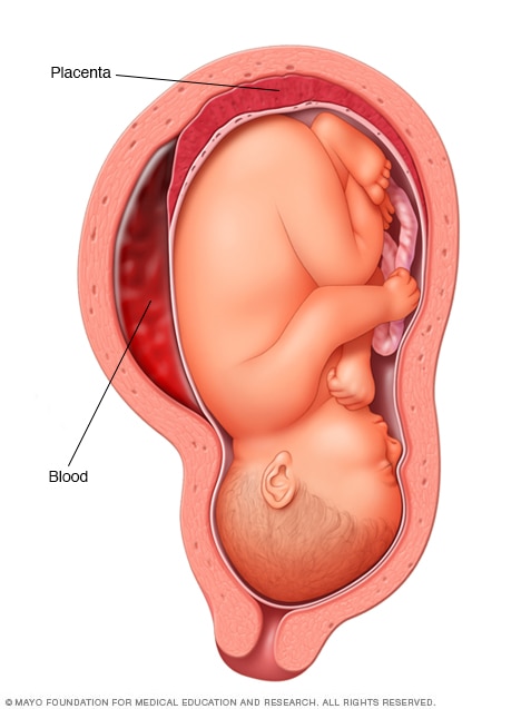 Desprendimiento prematuro de placenta