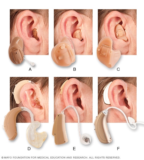 Tipos de audífonos