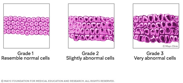 Tumor cells according to grade