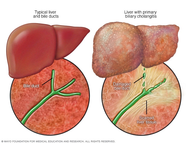 A typical liver and bile ducts and a liver and bile ducts affected by primary biliary cholangitis.