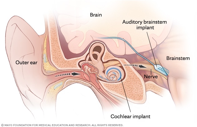 Diagram showing how a cochlear implant connects to the hearing nerve and how an auditory brainstem implant connects to the brainstem.