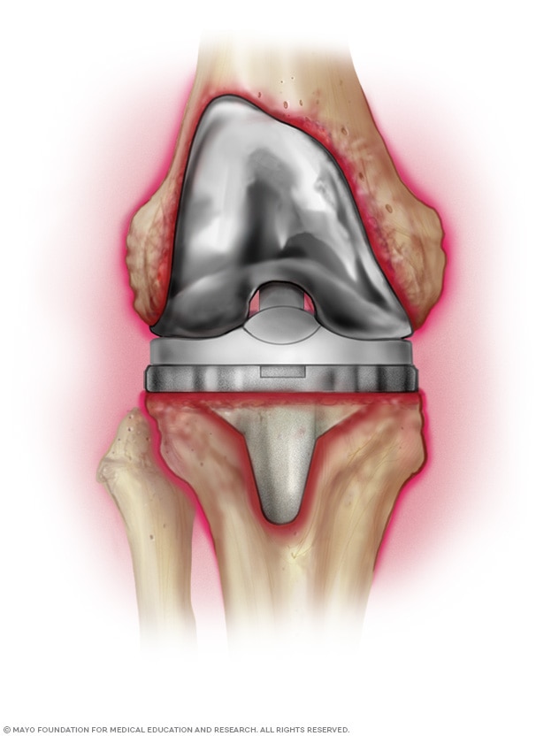Infected prosthetic knee joint