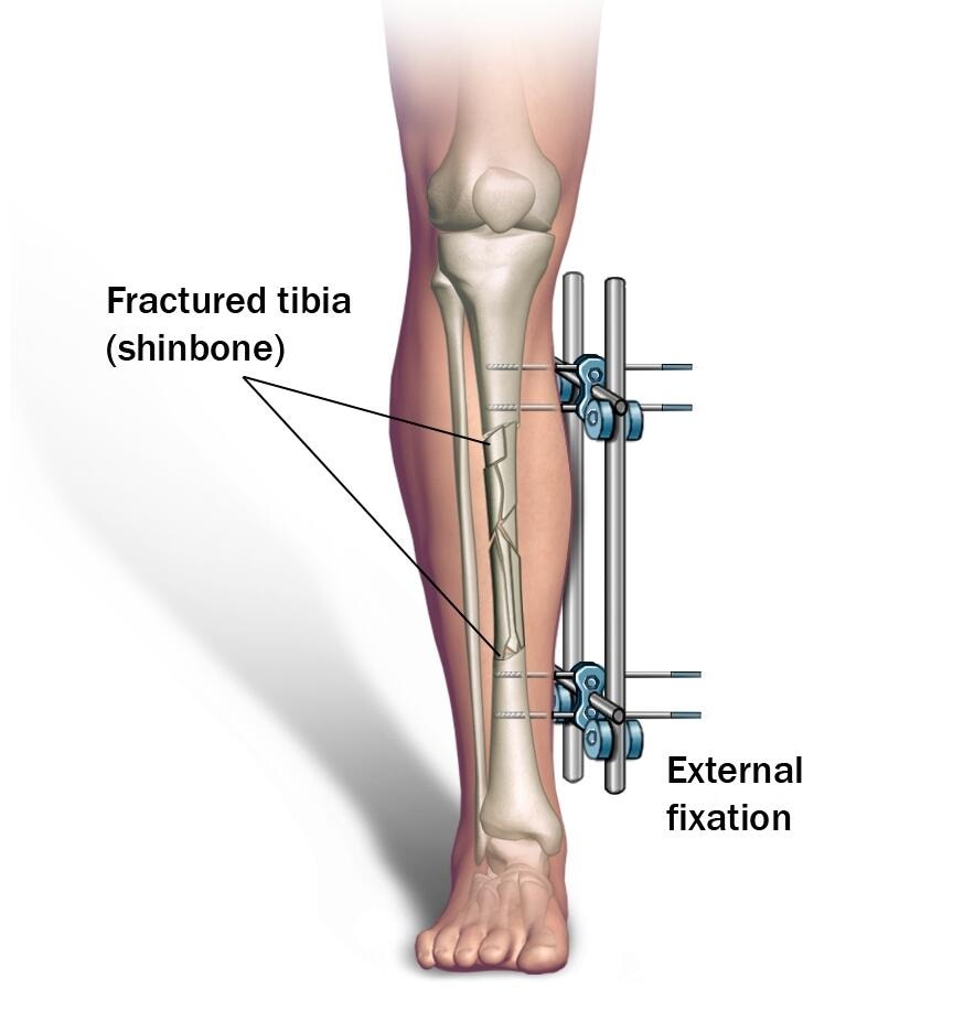 External fixation of the shinbone