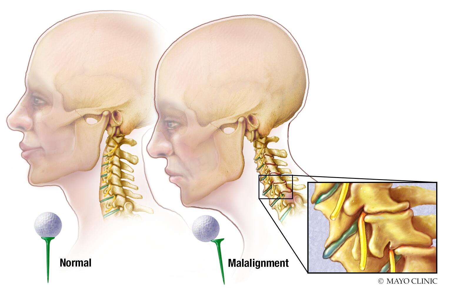 Bad posture using a comparison of a golf ball balanced on a tee to demonstrate proper alignment.