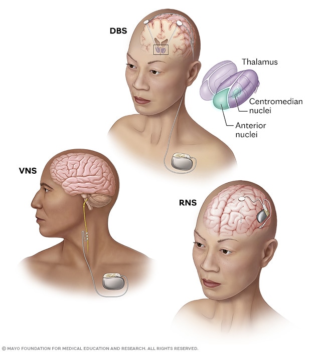 Vagus nerve stimulation, deep brain stimulation and responsive neurostimulation