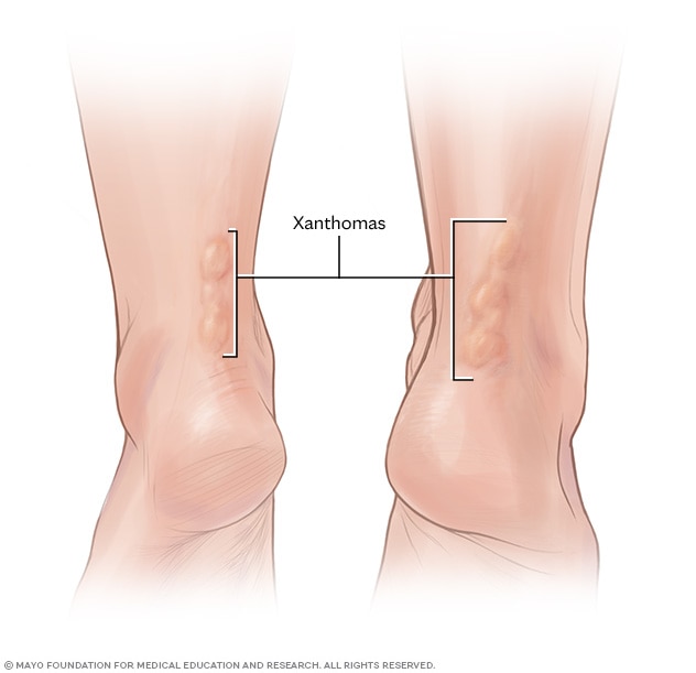 Cholesterol deposits on the Achilles tendon called xanthomas