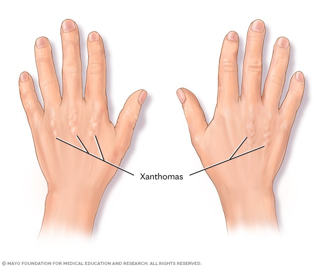 Cholesterol deposits on the hands called xanthomas