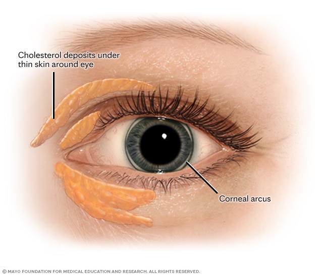 Cholesterol deposits around the eye and corneal arcus