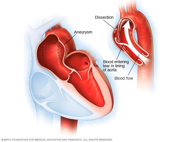 Illustration showing an aortic dissection and aortic aneurysm