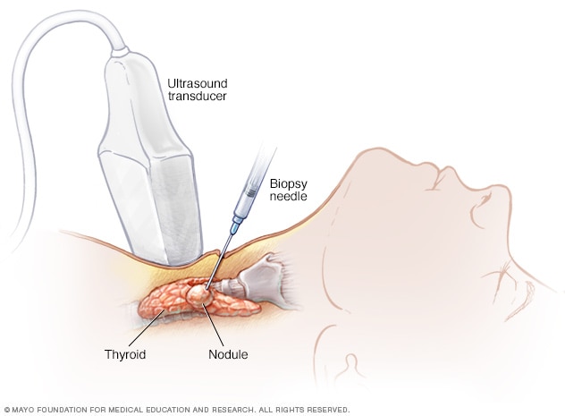 Biopsia con aguja de cáncer de tiroides