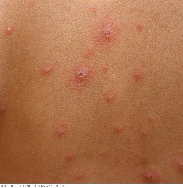 Chickenpox