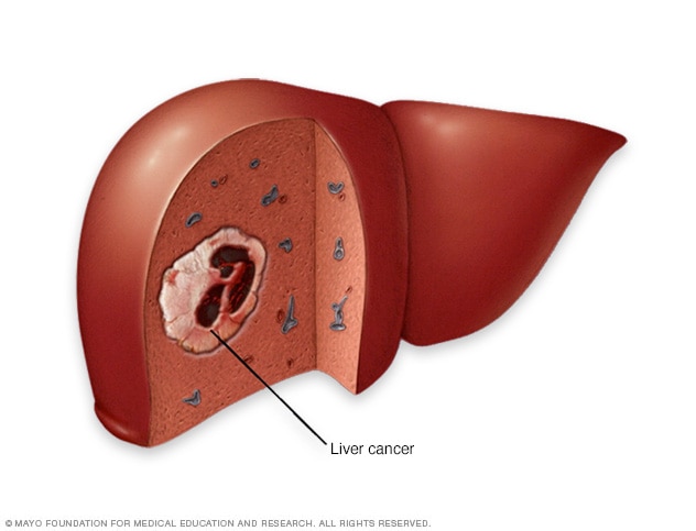 A liver with cancer