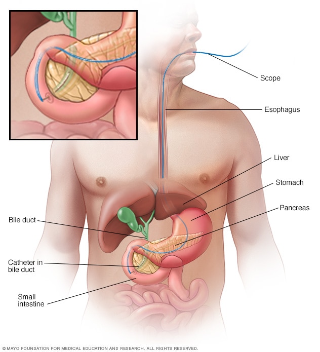 Illustration of a scope passing through the esophagus to place a catheter into the bile duct near the pancreas.