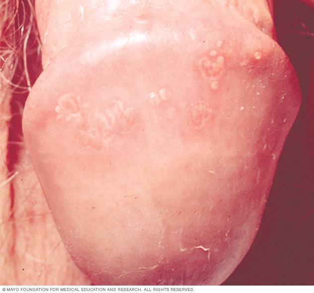 Ampollas de herpes genitales en el pene