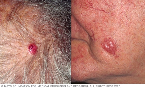 Photograph showing Merkel cell carcinoma