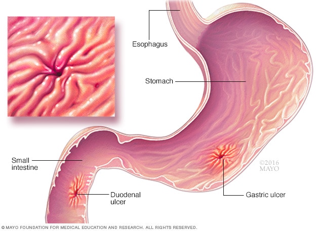 Ulcers