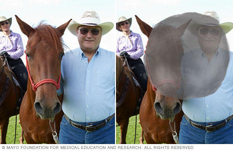 Photographs depicting typical vision and vision with macular degeneration.