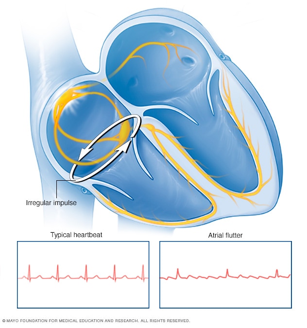 Illustration showing atrial flutter