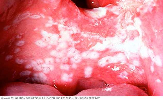 Candidiasis bucal