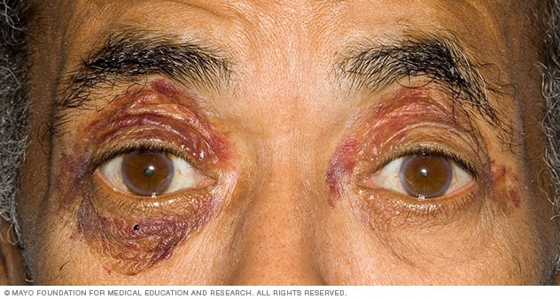 Dark or purple patches around the eyes, a sign of amyloidosis