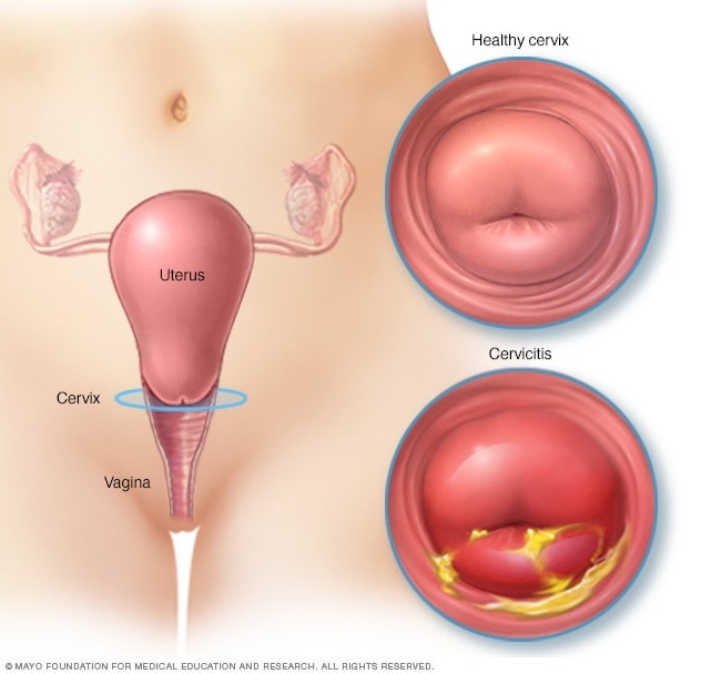 Illustration of normal cervix and cervix with cervicitis