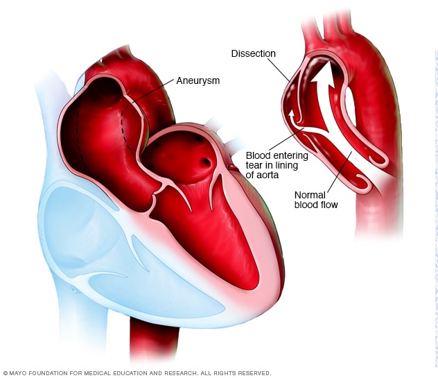 Illustration showing an aortic aneurysm and dissection.