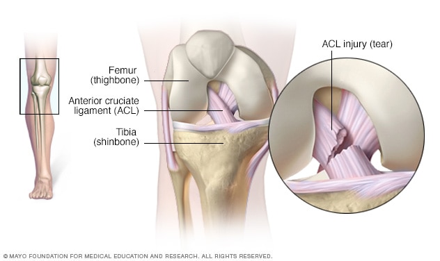 Illustration showing anterior cruciate ligament