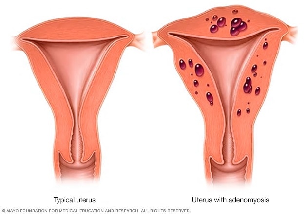 Illustration showing typical uterus vs. uterus with adenomyosis