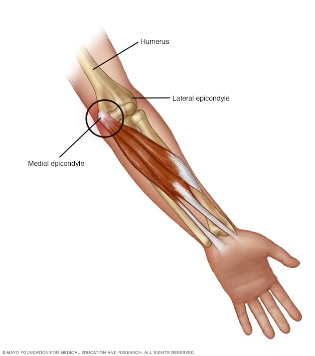 Illustration of golfer's elbow
