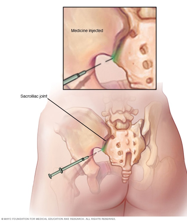 Illustration showing placement of sacroiliac injection