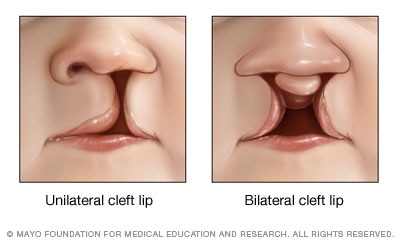 Labio hendido unilateral y bilateral