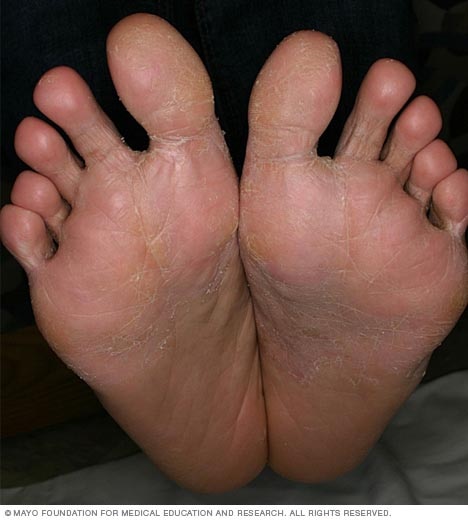 汗疱症