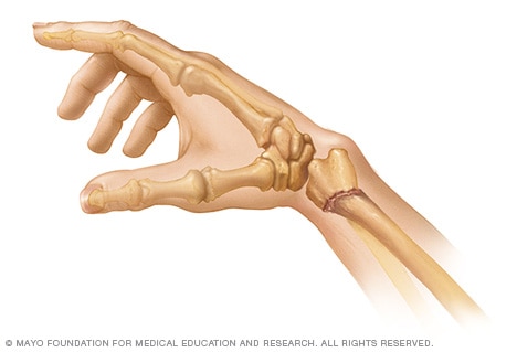 Colles fracture