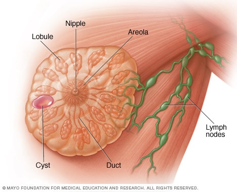 Illustration of a breast cyst