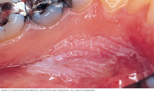 Leucoplasia