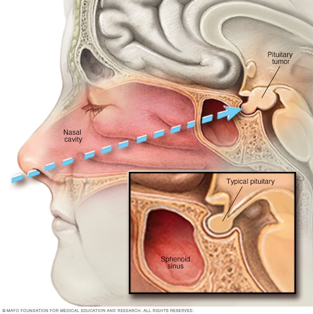 Cirugía transesfenoidal transnasal
