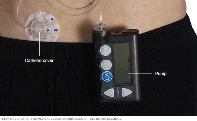 Illustration showing an insulin pump