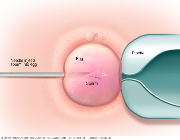 Illustration showing a single sperm injected into an egg during an ICSI procedure