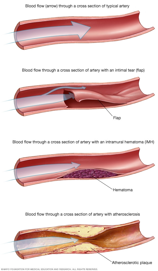 Blood flow in arteries in spontaneous coronary artery dissection (SCAD)