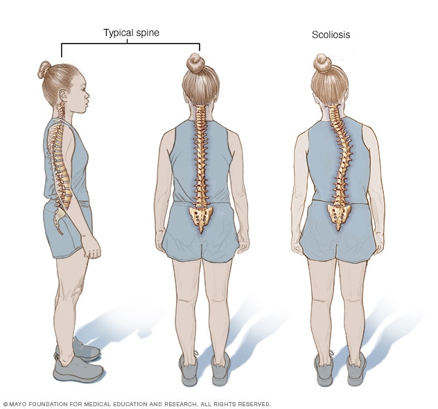 Illustration comparing typical curves in spine with scoliosis.