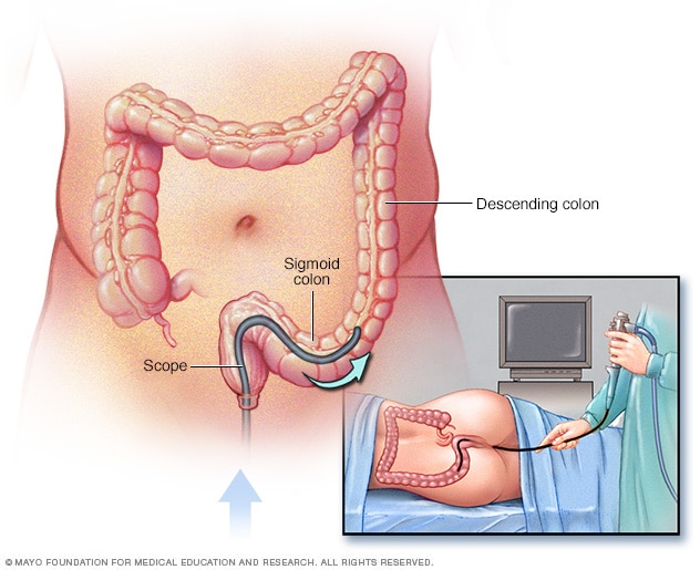 Illustration of flexible sigmoidoscopy exam