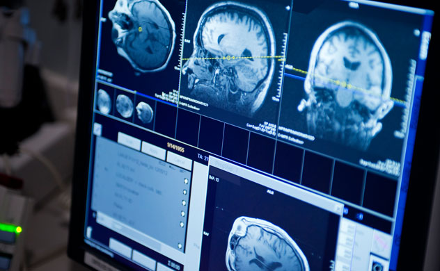 Brain tumor MRI image