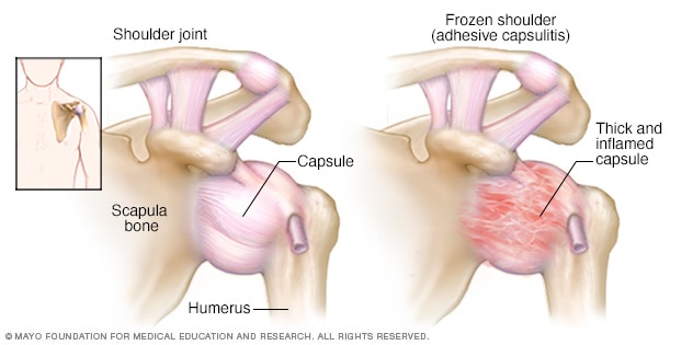 Illustration showing shoulder joint and frozen shoulder